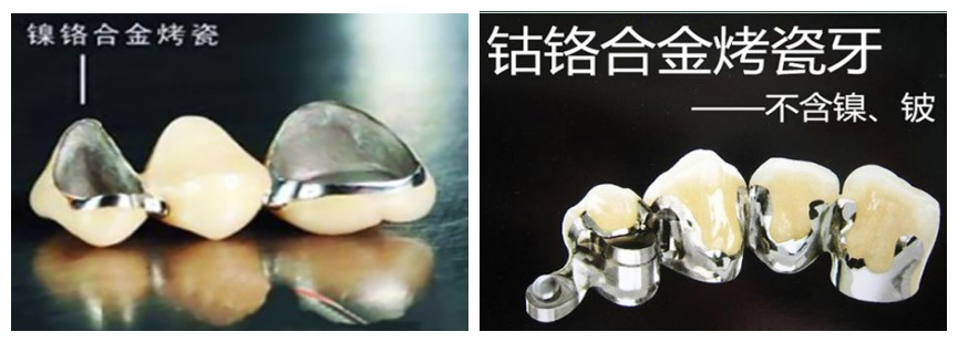 金属烤瓷牙和不含重金属.jpg