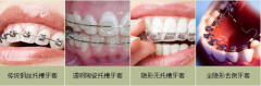 矫正牙套有哪些种类
