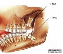尽早清除你嘴里的“定时炸弹”——智齿