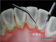 牙齿上有“石头”是咋回事?快来看看!