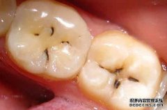 牙齿上的小黑点刷不掉?是咋回事?