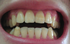 怎样才是科学的美白牙齿?