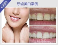 炫彩美白，30分钟解决各种色素牙