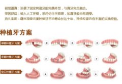 种牙要多少时间?1小时种颗好牙