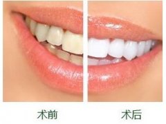 牙齿上的黄渍如何去除?