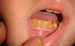 小孩出现黄牙是什么原因呢?