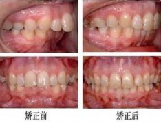 广州哪家医院矫正牙齿好?