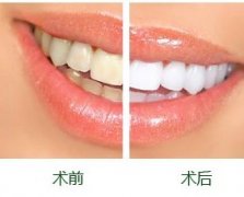 广州圣贝专家揭晓为什么牙齿会变黄