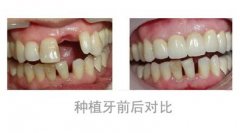 牙齿修复去哪家医院比较好?