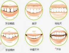 广州牙齿矫正哪种方法好
