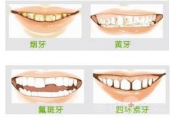 牙齿美白什么方法好