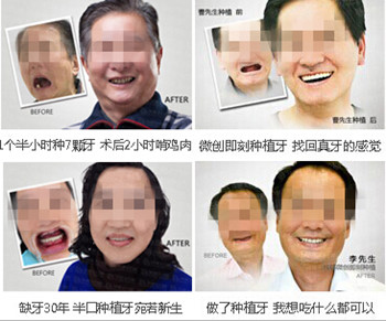 完美补位缺牙 种植牙多少钱一颗3