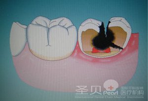 蛀牙治疗要多少钱