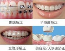 牙齿矫正哪家医院好