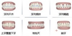 牙齿矫正多少钱