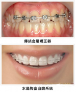 陶瓷半隐形正畸