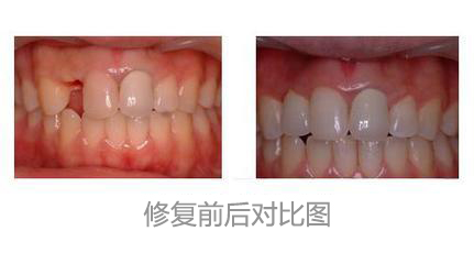 门牙掉了采用什么方法修复好?