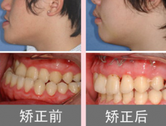 龅牙矫正要多少钱