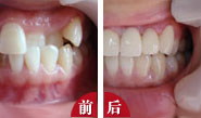 美容冠修复