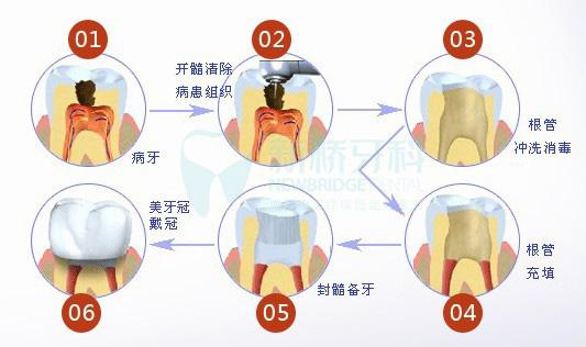 根管治疗.jpg