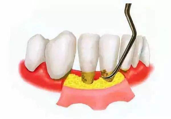 牙槽骨吸收..jpg
