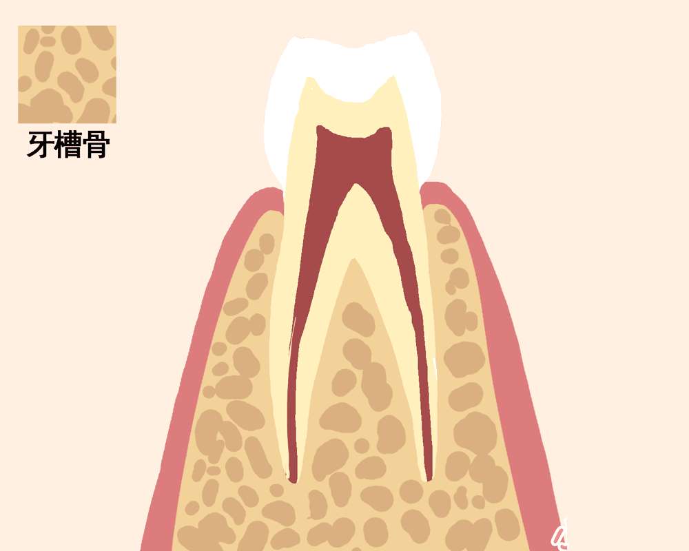 牙槽骨吸收...jpg