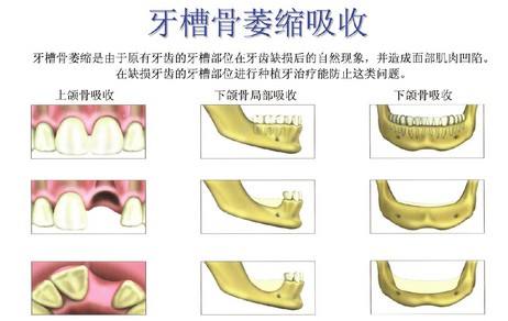 牙槽骨吸收.jpg