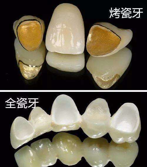 烤瓷牙...jpg