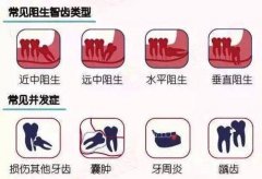广州智齿拔了多少钱