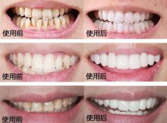 广州牙齿美白价格