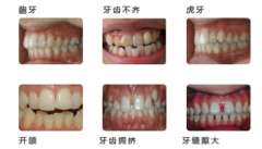 广州成人牙齿矫正一般多少钱