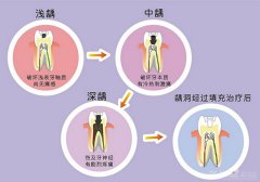 广州补牙用什么材料