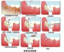 智齿疼痛怎么办?广州圣贝