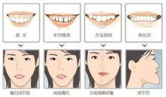 广州牙齿矫正要多久?