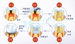 广州去医院补牙多少钱？