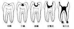 浅谈蛀牙的“三级预防”